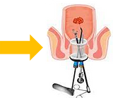Polypes du Rectum