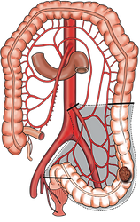prolypes et cancer du colon 5.png