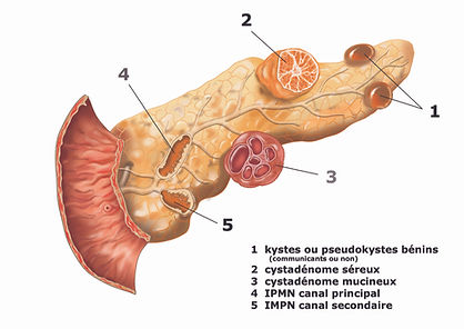Kystes et Tumeurs du Pancréas