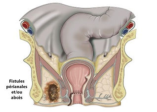 Maladie de Crohn et Rectocolite ulcéro-hémorragique