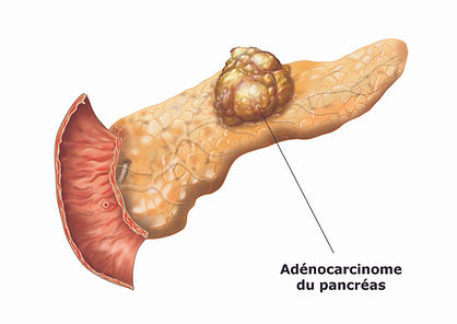 Kystes et Tumeurs du Pancréas