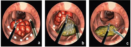Polypes du Rectum