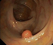 Polypes du Rectum