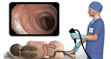 prolypes et cancer du colon 1.tif