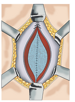 Éventration Abdominale