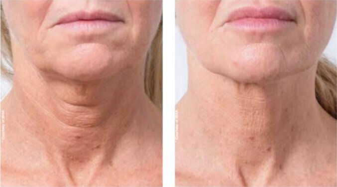 Profhilo results on neck
