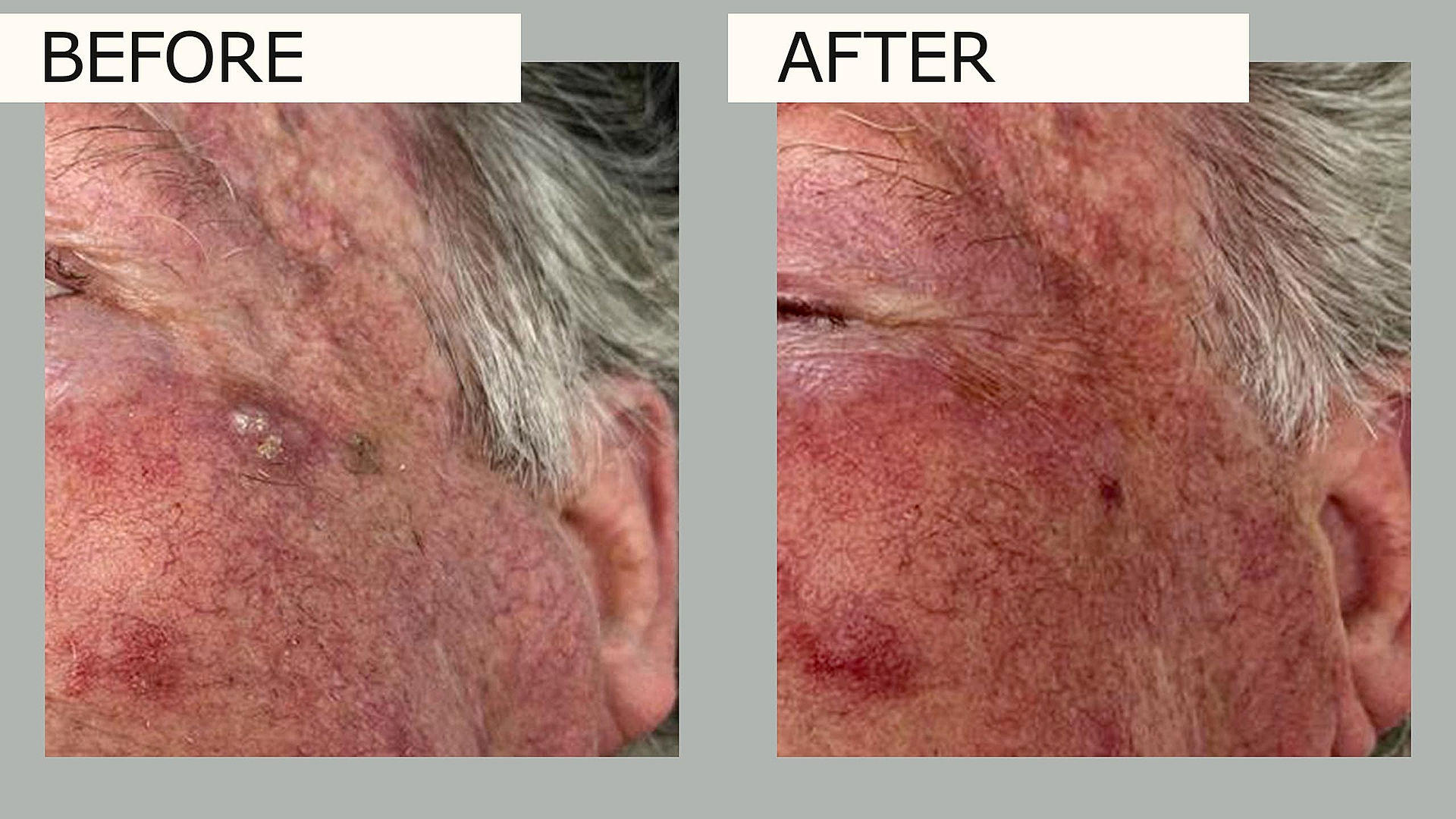 The image showcases improved skin texture and tone, highlighting the transformative effects of our advanced laser procedures.