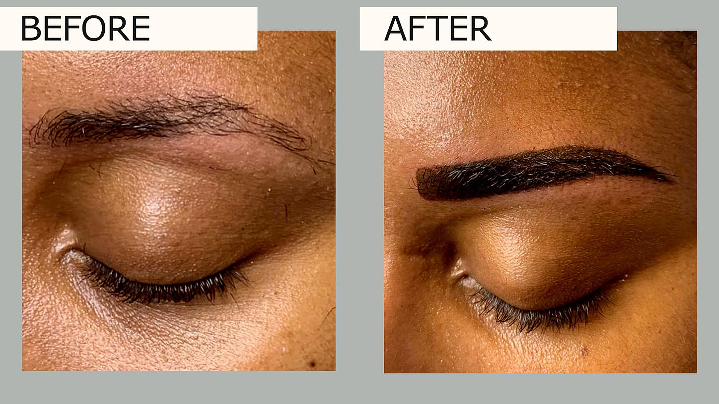 The image showcases improved skin texture and tone, highlighting the transformative effects of our advanced laser procedures.