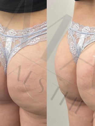 Hip & Butt Fillers _ London.png