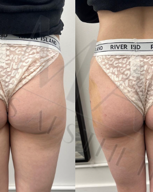 Butt & Hip Filler UK.png
