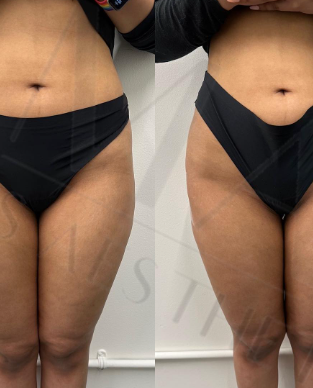 Buttocks & hip dip filler.png