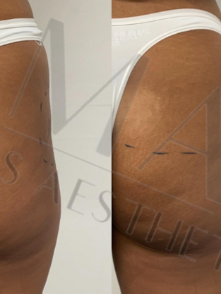 Hip & Buttocks Fillers London UK.png