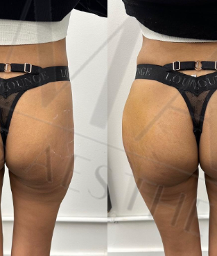 Hip and Butt Filler BBL.png