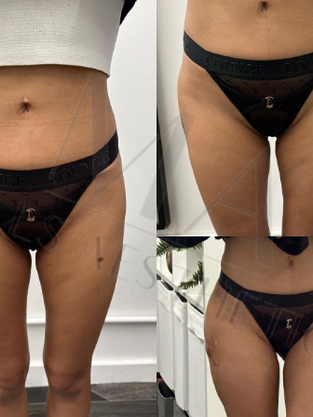 Hip & Butt Fillers London.png