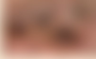 Realiza SESA vigilancia epidemiológica de viruela símica