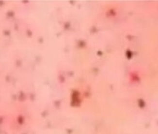 Efectúa SESA vigilancia epidemiológica estatal de viruela símica