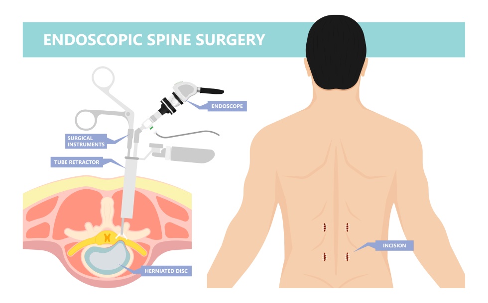 Encoscopic spine surgery