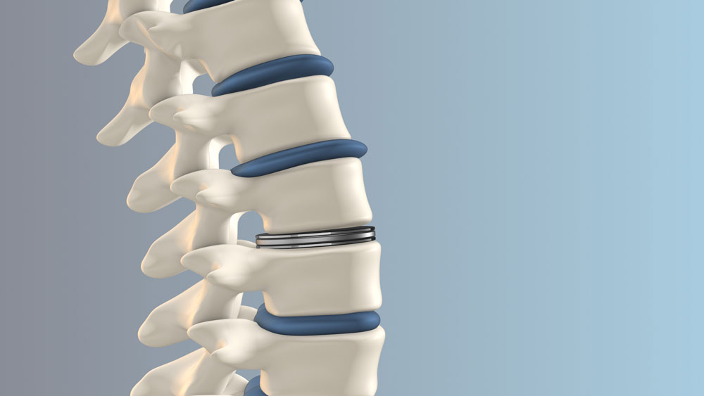 Lumbar disc replacement