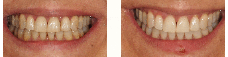 ejemplos-blanqueamiento-dental-bilbao.gif