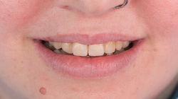 Desgaste dental Ortodoncia