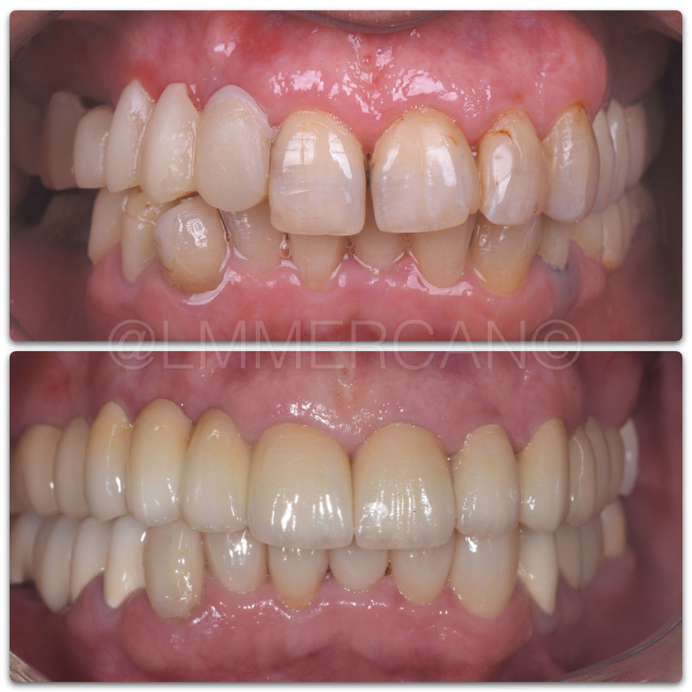 Smile Design By L. Murat MERCAN with Laminate Veneers