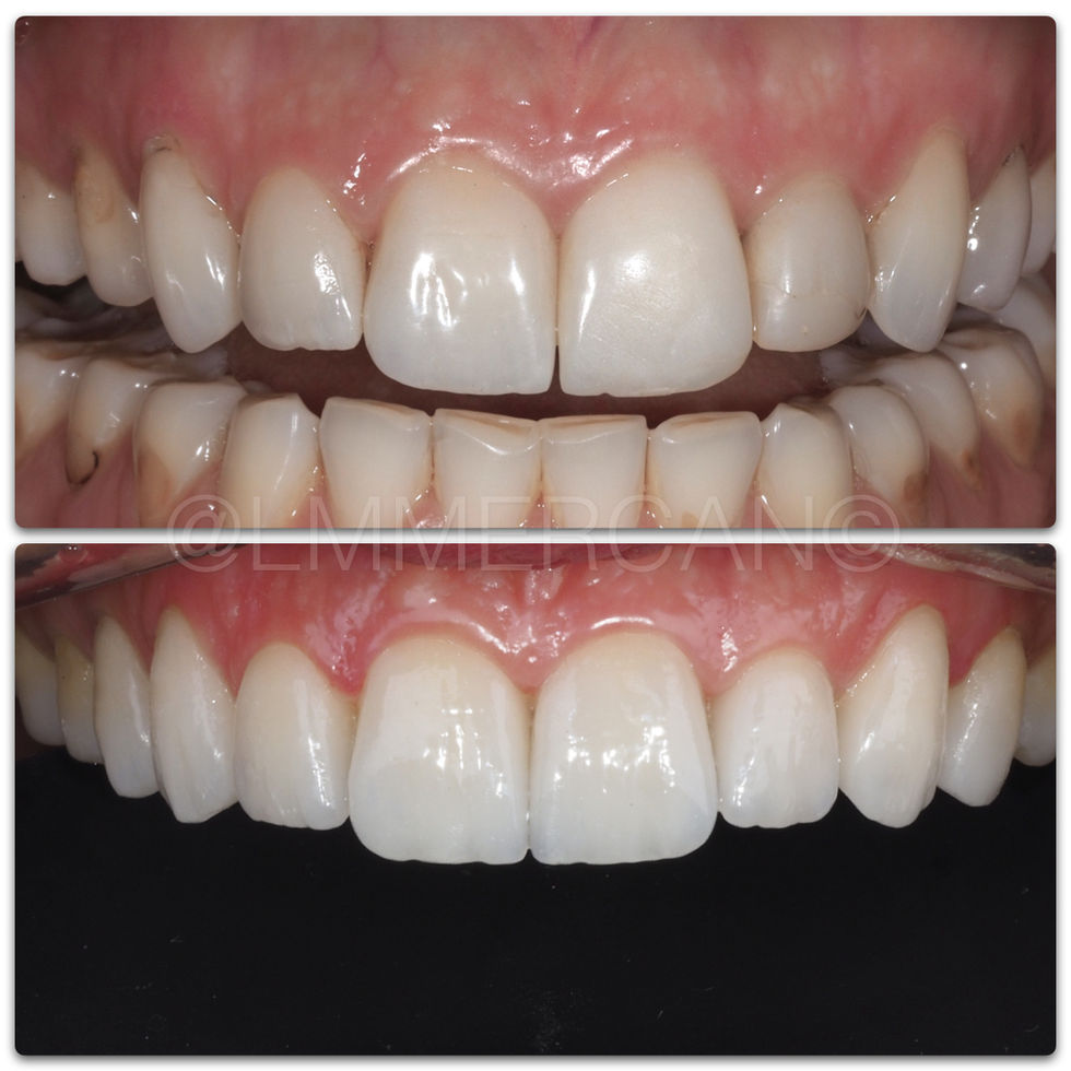 Smile Design By L. Murat MERCAN with Laminate Veneers