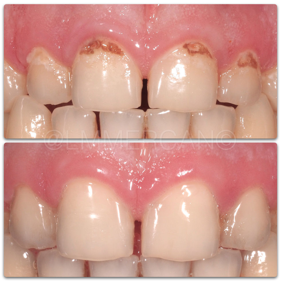 Smile Design By L. Murat MERCAN with composite fillings