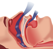 Illustration showing sleep apnea and airway obstruction