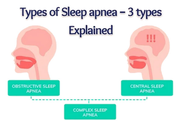 Sleep Apnea Types, OSA, Sleep Study, CPAP Machine, OSA, Anti Snoring Insomia Doha Qatar