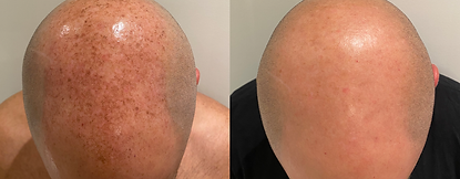 removal of Hyperpigmentation