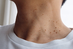 Eurolab Aesthetic Singapore Skin Tags.jpeg