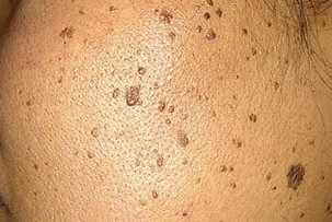 Eurolab Aesthetic Singapore Age Warts.jpg