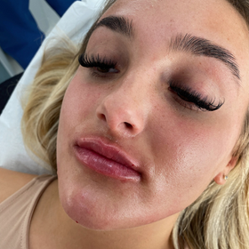 Sarah Railton Medical Aesthetics | Hartlepool lip filler