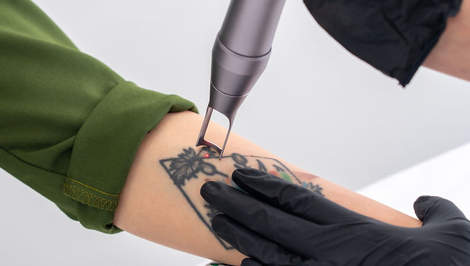 TATTOO REMOVAL