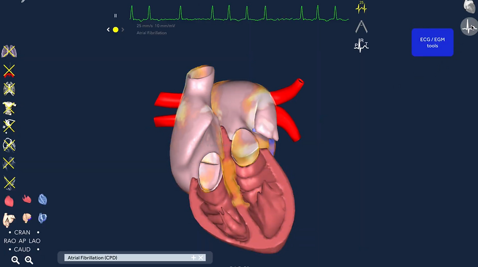 Am I Too Old for AF Ablation? Atrial Fibrillation Treatment Explained