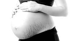 Trattamento smagliature | Eliminare smagliature | Soluzione smagliature gravidanza smagliature allattamento