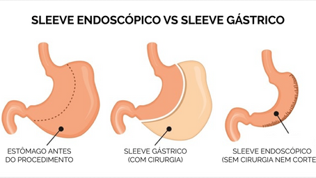 Diferenças entre o Sleeve Endoscópico e o Sleeve Gástrico