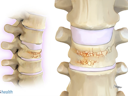 Natural Techniques to Simplicity Anxiousness and Soreness Before a Bone Sca