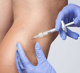 5 things to know about sclerotherapy for spider….jfif