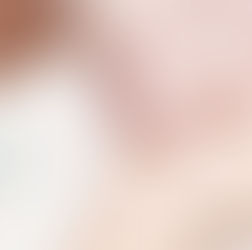 Ante brote de sarampión en Estados Unidos, prende alertas para mexicanos