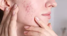 Close-up of a woman with acne scars and blemishes on her cheek, touching her skin. 