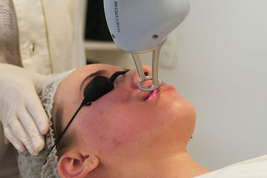 Paciente recendo aplicação de laser lavies no rospro proximo aos lábios