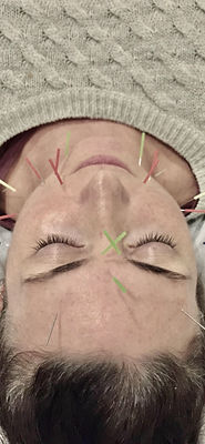 kelli howard zen medicine cosmetic acupu