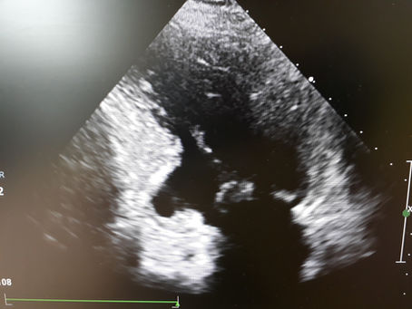 L'infarto c'e' stato e si vede..