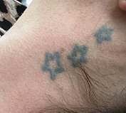 tattoo-removal-5.jpeg