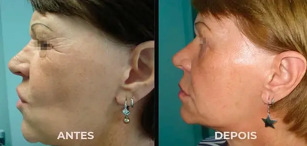 Antes e depois Acupuntura estética facial