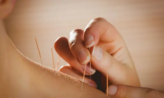 acupuntura-para-fibromialgia.webp