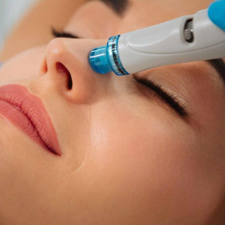 HydraFacial For Acne-Prone Skin: Clearing Blemishes And Restoring Clarity