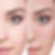 Woman before and after treatment.jpg
