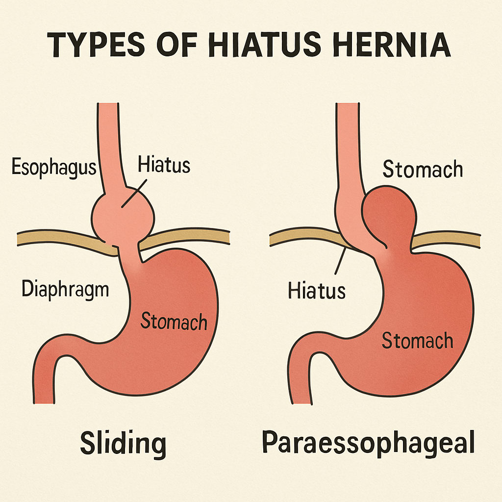 Hiatus Hernia Causes Symptoms Treatment Hiatus Hernia Causes Symptoms Treatment